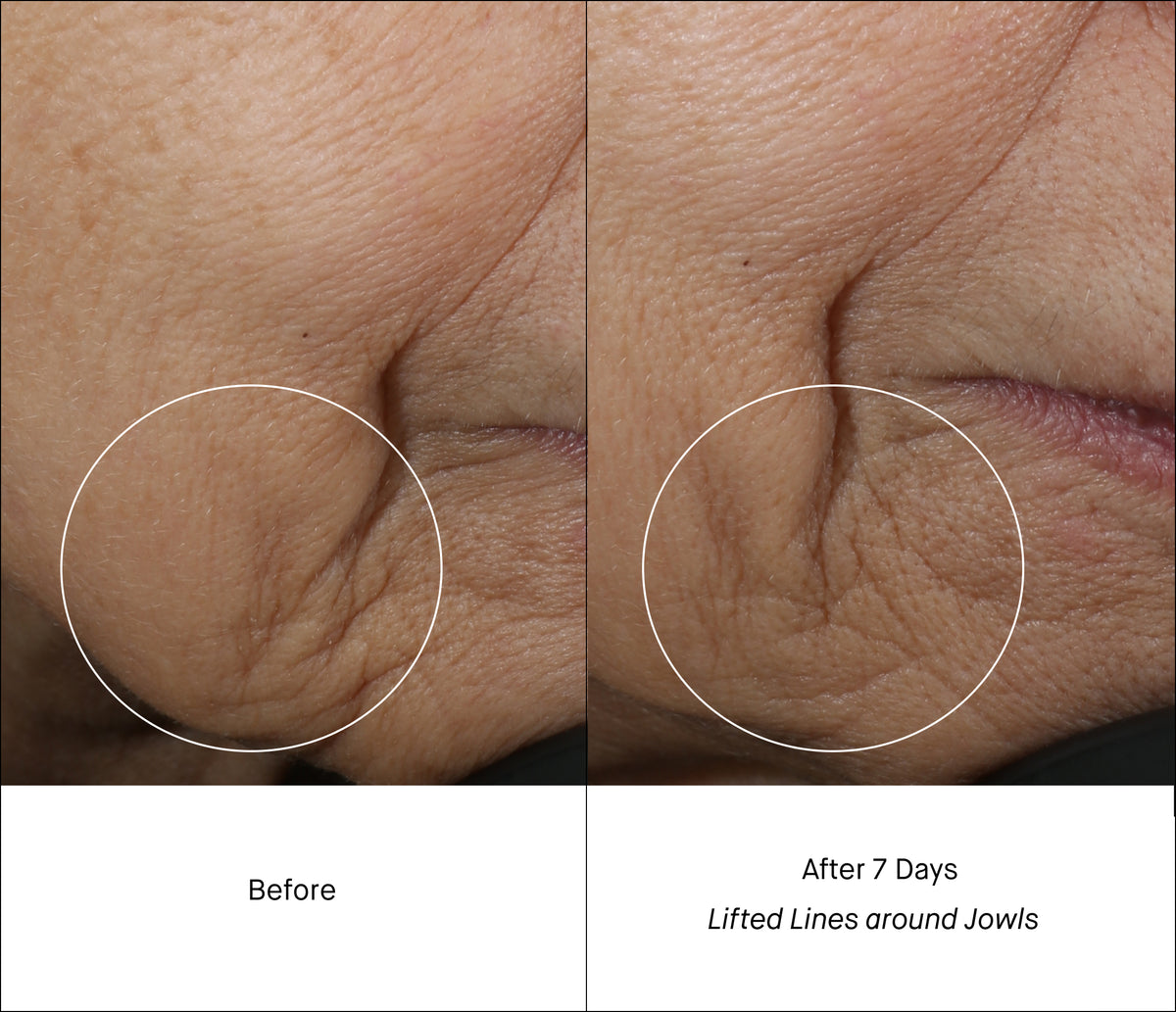 Jowls Lines Before & After 7 Days of Treatment