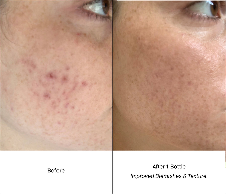 Before and After 1 bottle of Shani Darden Retinol Reform Comparison - Decrease Blemishes