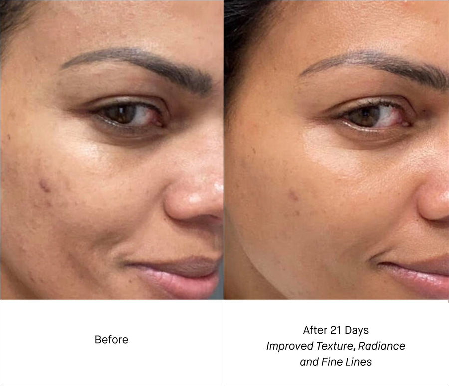 Before and After 1 bottle of Shani Darden Retinol Reform Comparison - Even Skin Tone and Reduce Blemishes