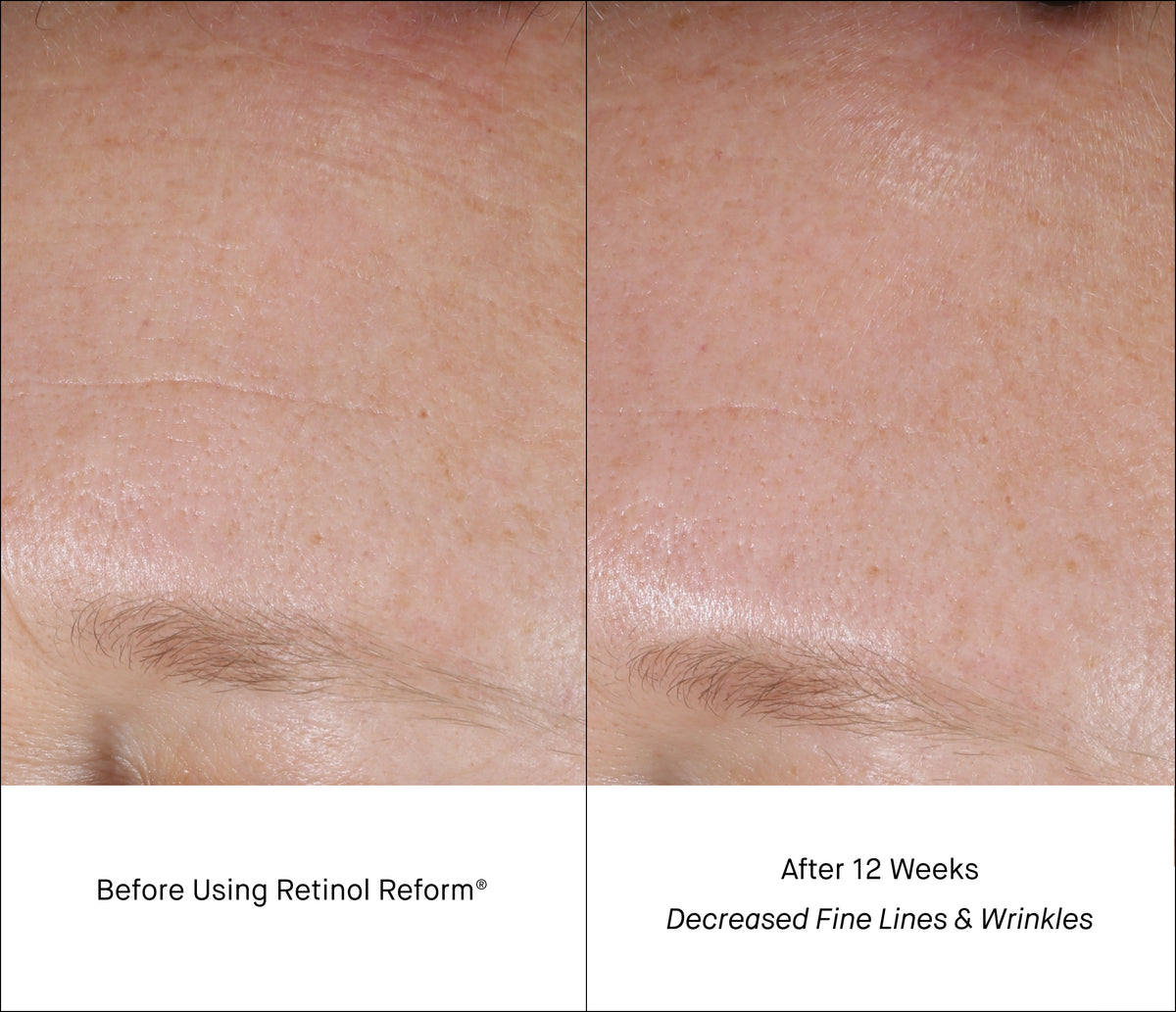 Before and After 12 Weeks of Shani Darden Retinol Reform Comparison - Reduced Fine Lines & Wrinkles